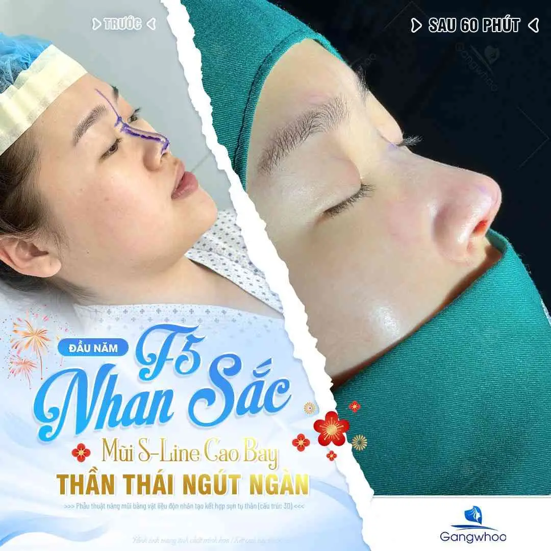 Những nguyên nhân khiến mũi bị nâng quá cao