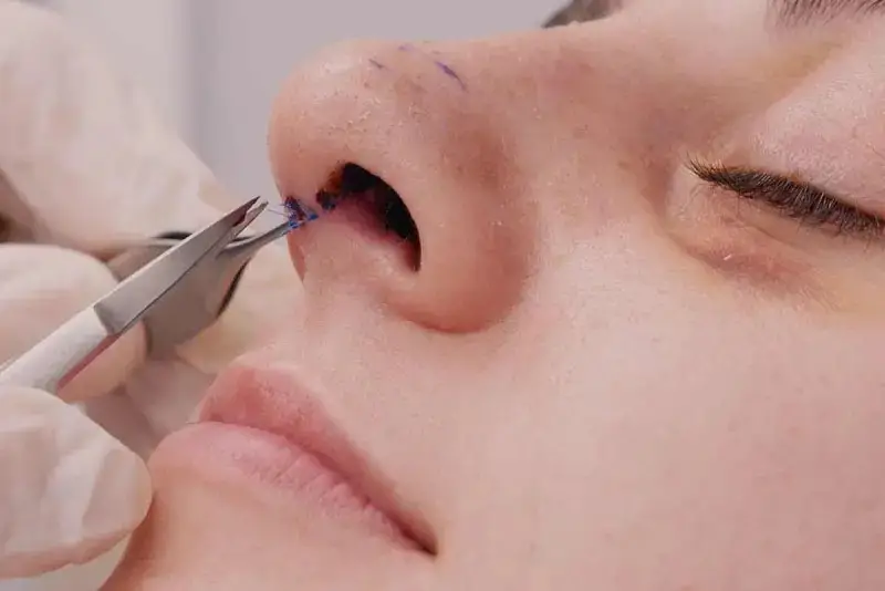 Tình trạng nâng mũi bị cắt sót chỉ