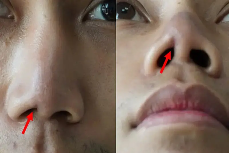 Tình trạng nâng mũi bị co rút là gì?