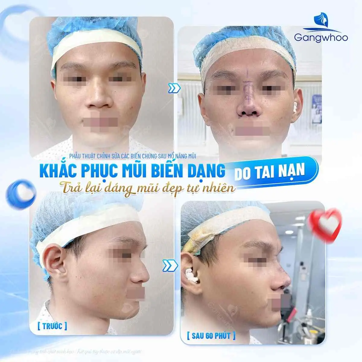 Những nguyên nhân khiến xảy ra tình trạng mũi bị co rút