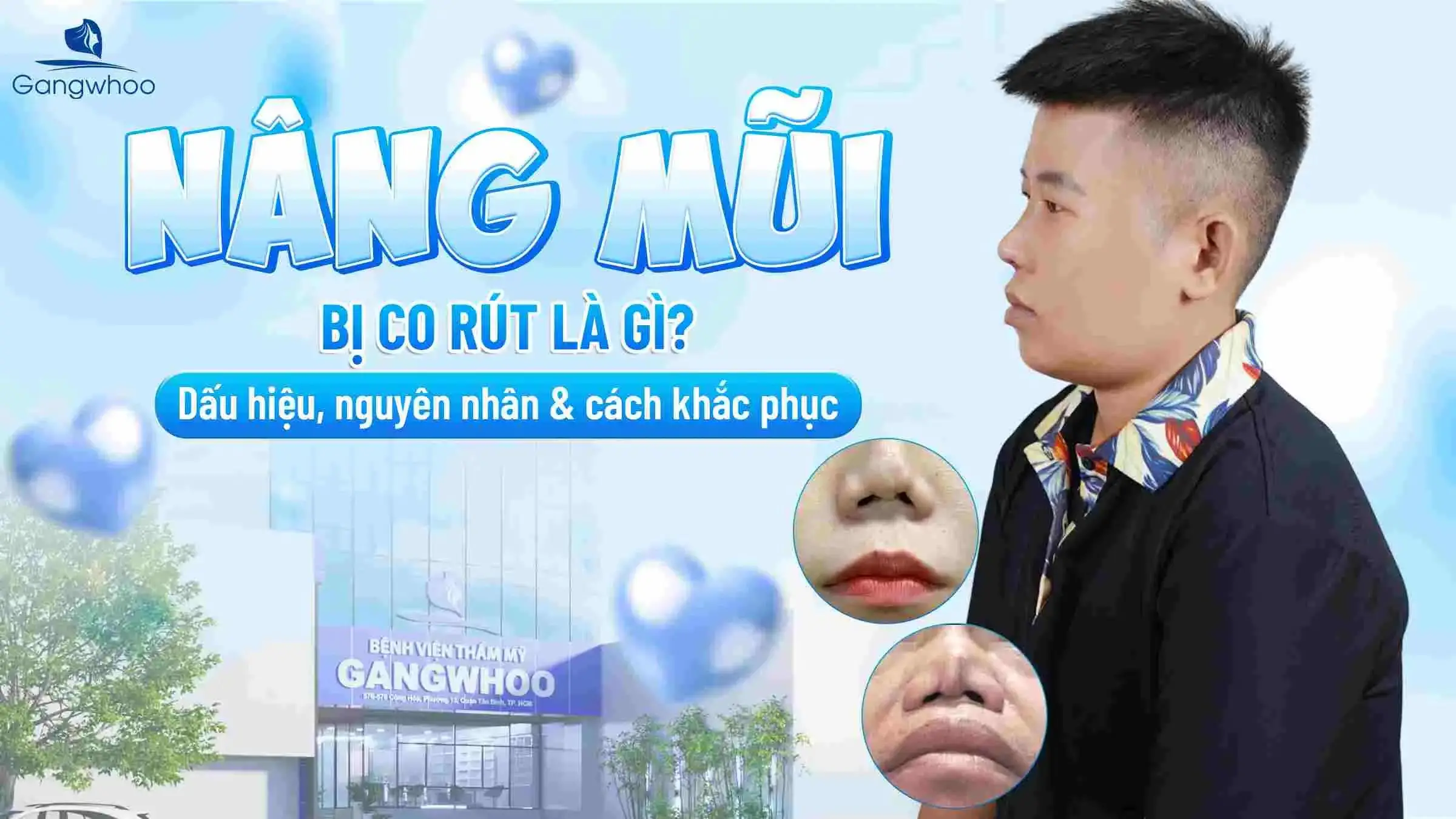 Nâng Mũi Bị Co Rút Là Gì? Dấu Hiệu, Nguyên Nhân & Cách Khắc Phục