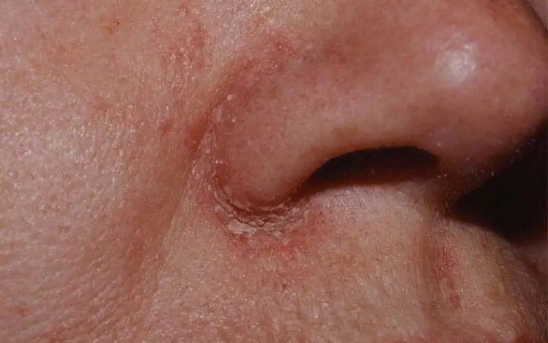 Vết mổ nâng mũi đóng mài có sao không?