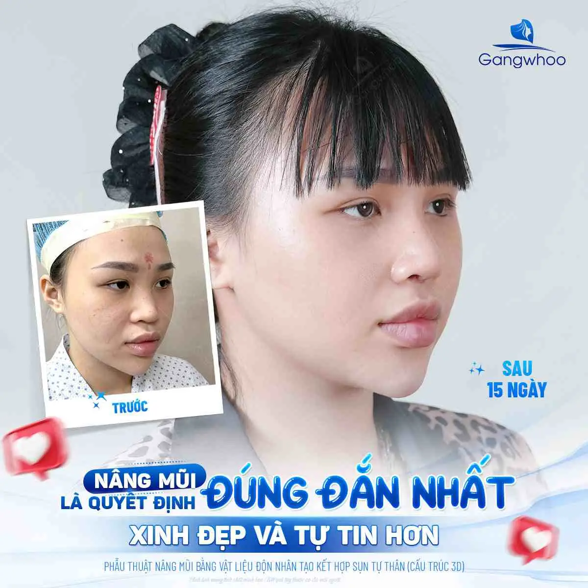 Những nguyên nhân khiến mũi bị đóng mài