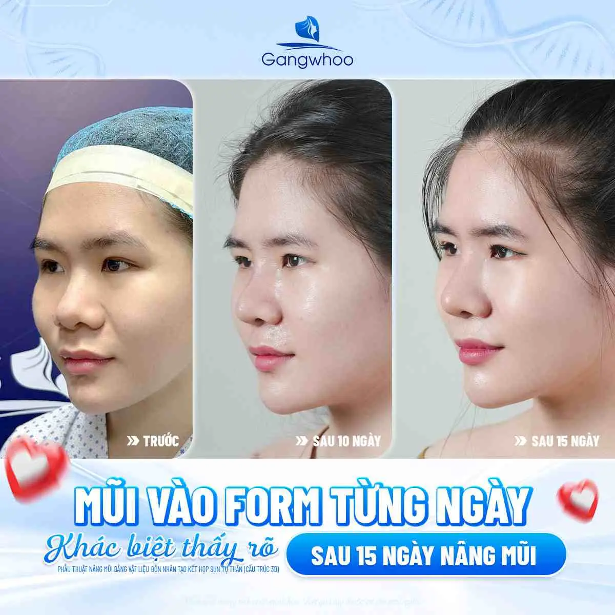 Quá trình phục hồi sau khi nâng mũi