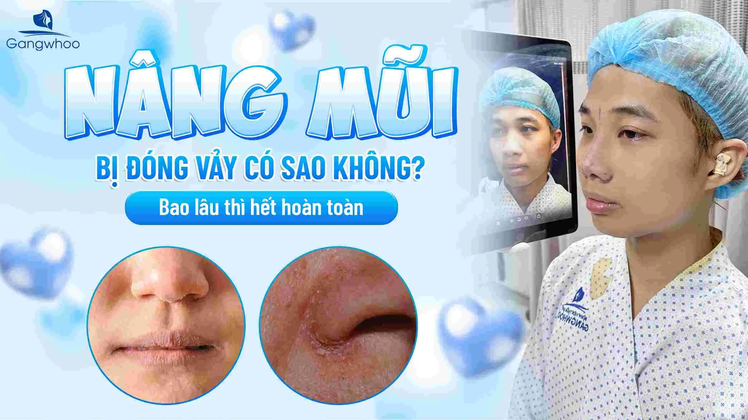 Nâng Mũi Bị Đóng Vảy Có Sao Không? Bao Lâu Thì Hết Hoàn Toàn