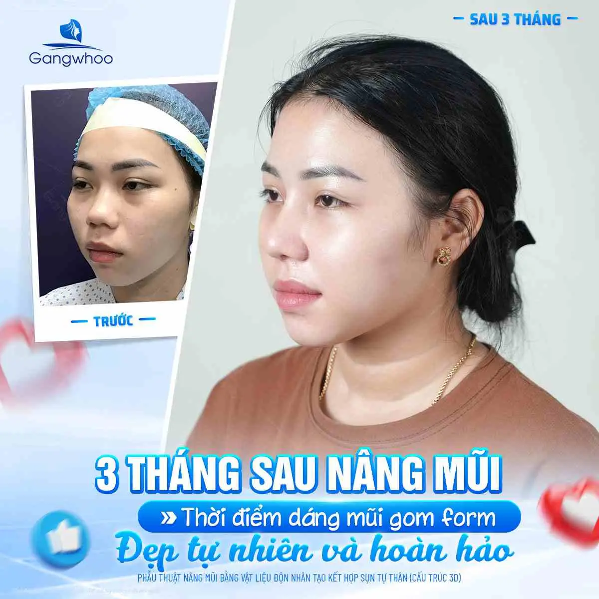 Nâng mũi bị hếch có tự hết không?