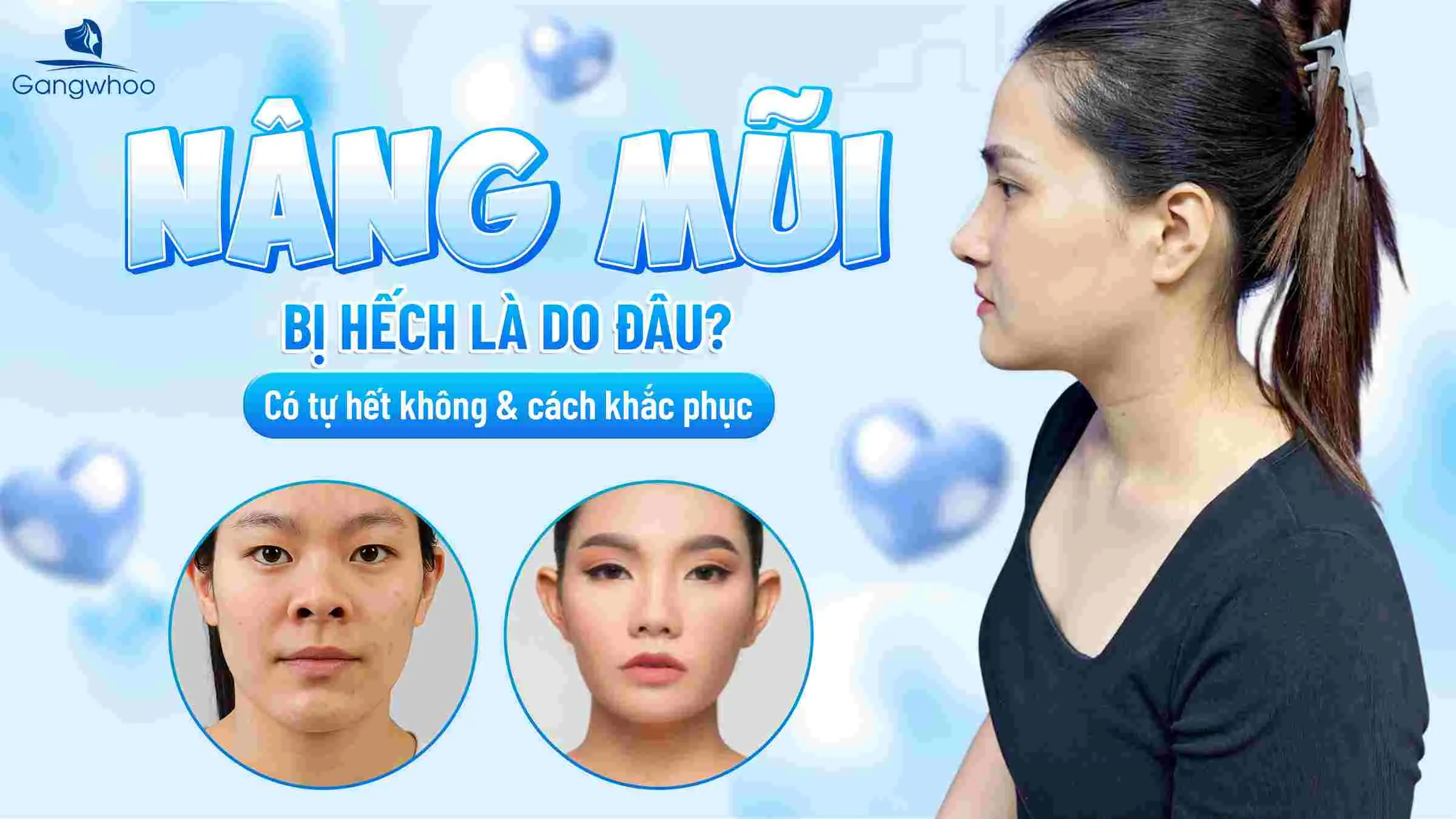Nâng Mũi Bị Hếch Là Do Đâu? Có Tự Hết Không & Cách Khắc Phục