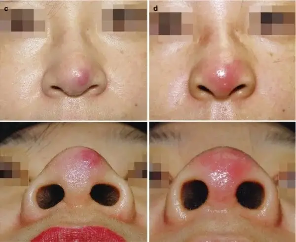 Da mũi mỏng, đỏ, căng bóng