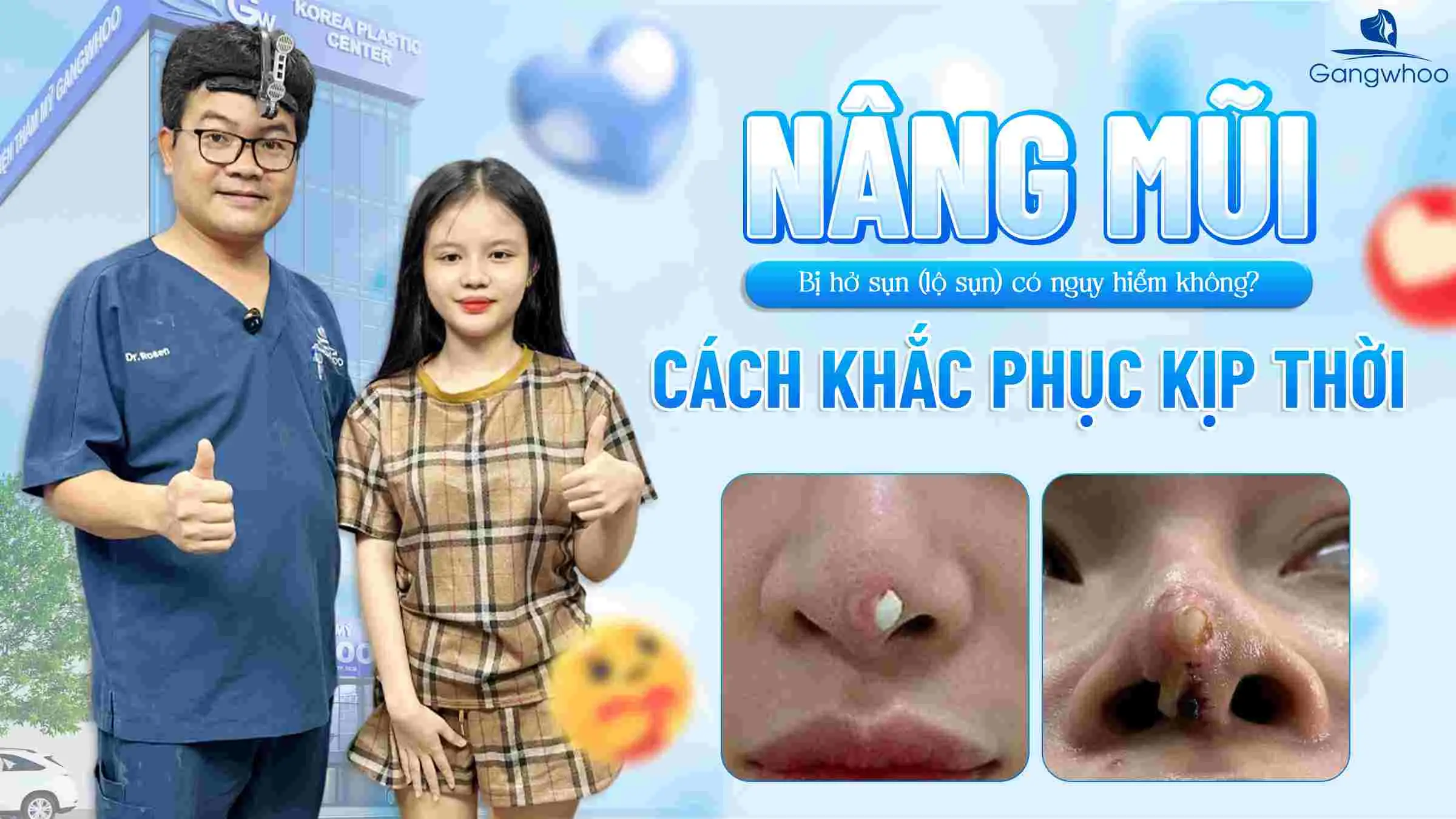 Nâng Mũi Bị Hở Sụn (Lộ Sụn) Có Nguy Hiểm Không? Cách Khắc Phục Kịp Thời