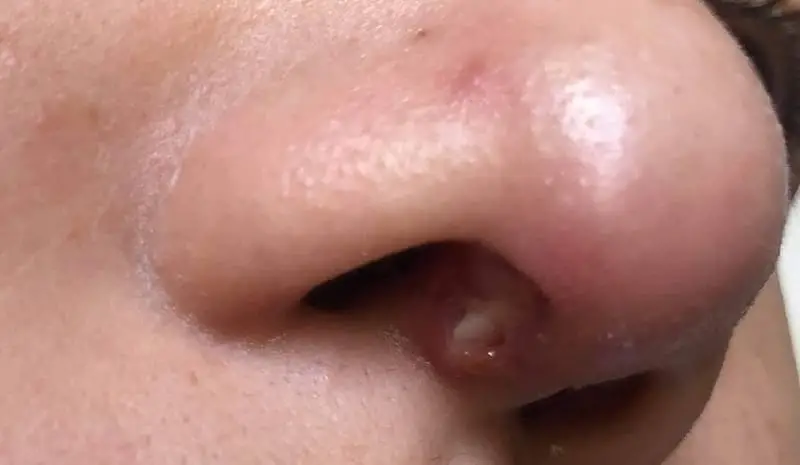 Tìm hiểu tình trạng nâng mũi bị hở vết thương