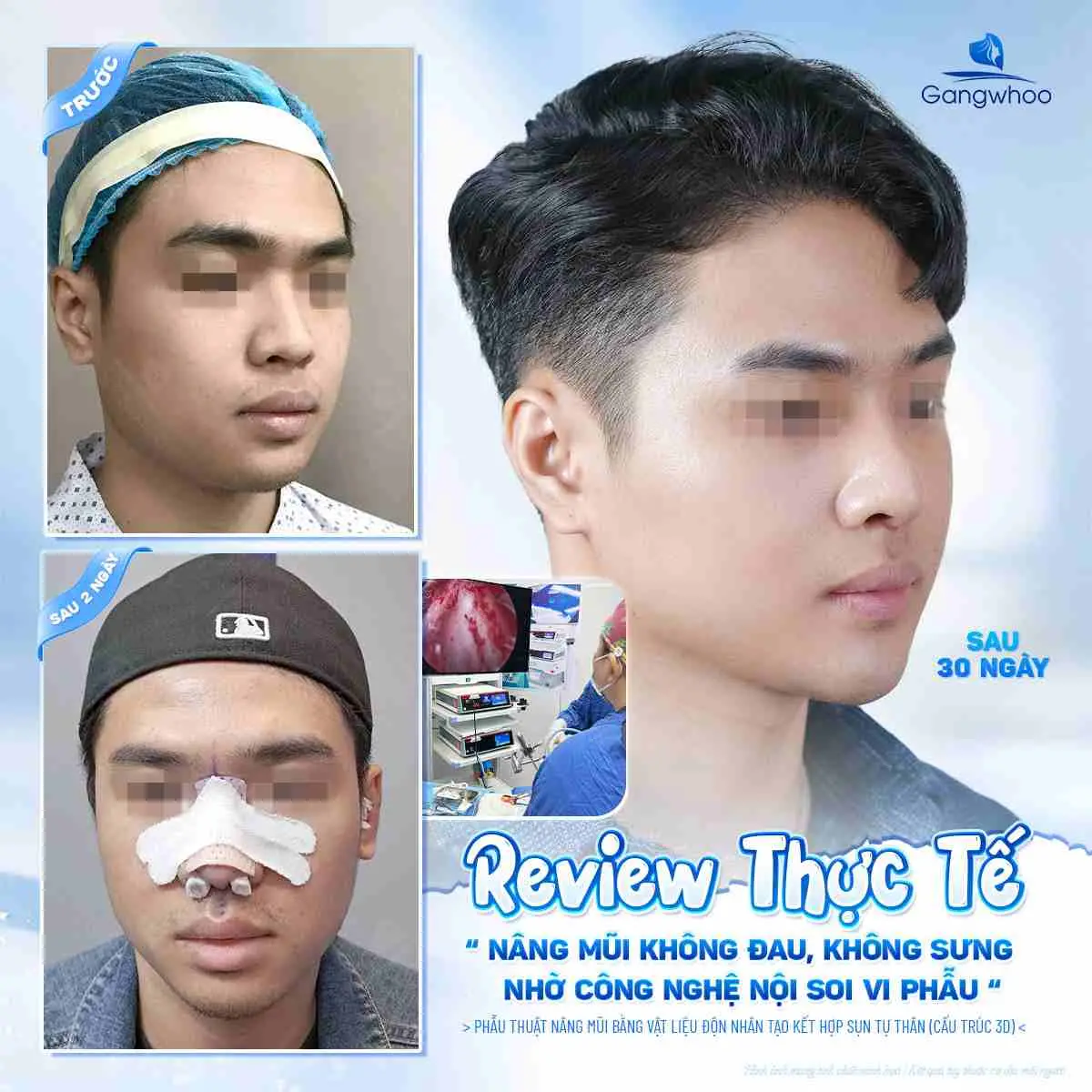 Dấu hiệu nhận biết vết thương nâng mũi bị hở nếu nâng mũi sai kỹ thuật