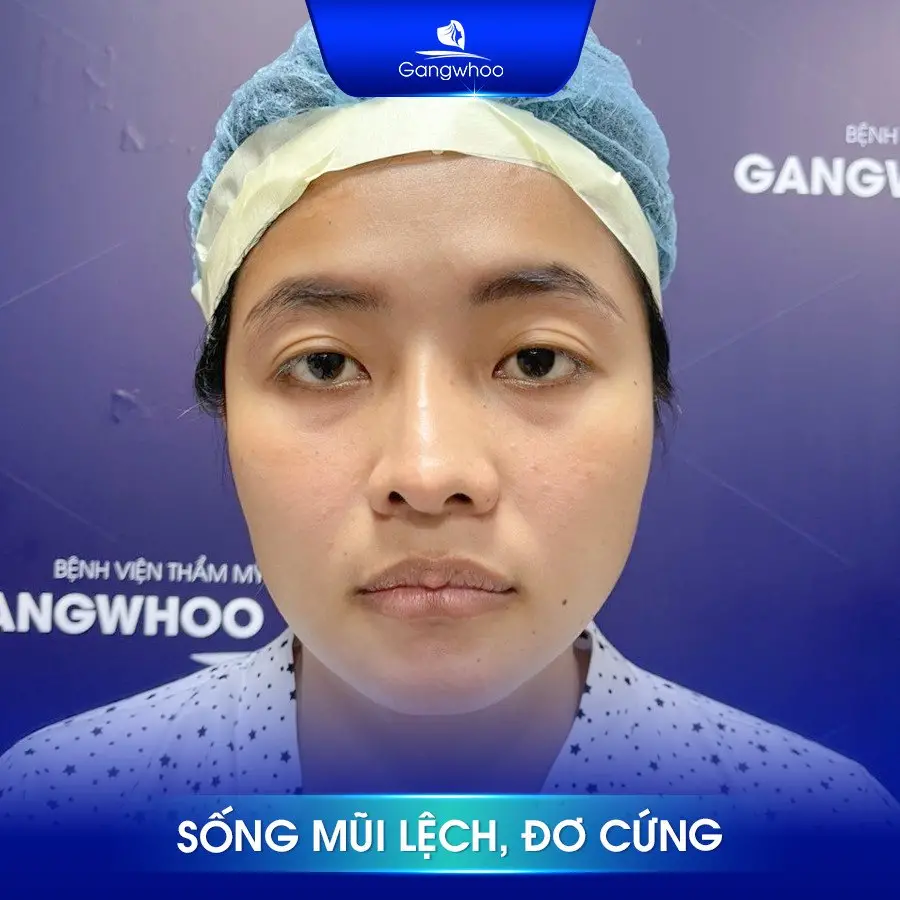 Nguyên nhân gây lệch vách ngăn