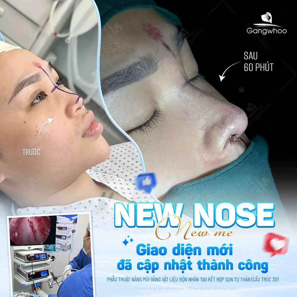 Nâng mũi tại Gangwhoo với tay nghề bác sĩ lâu năm sẽ giúp hạn chế tối đa biến chứng sau nâng