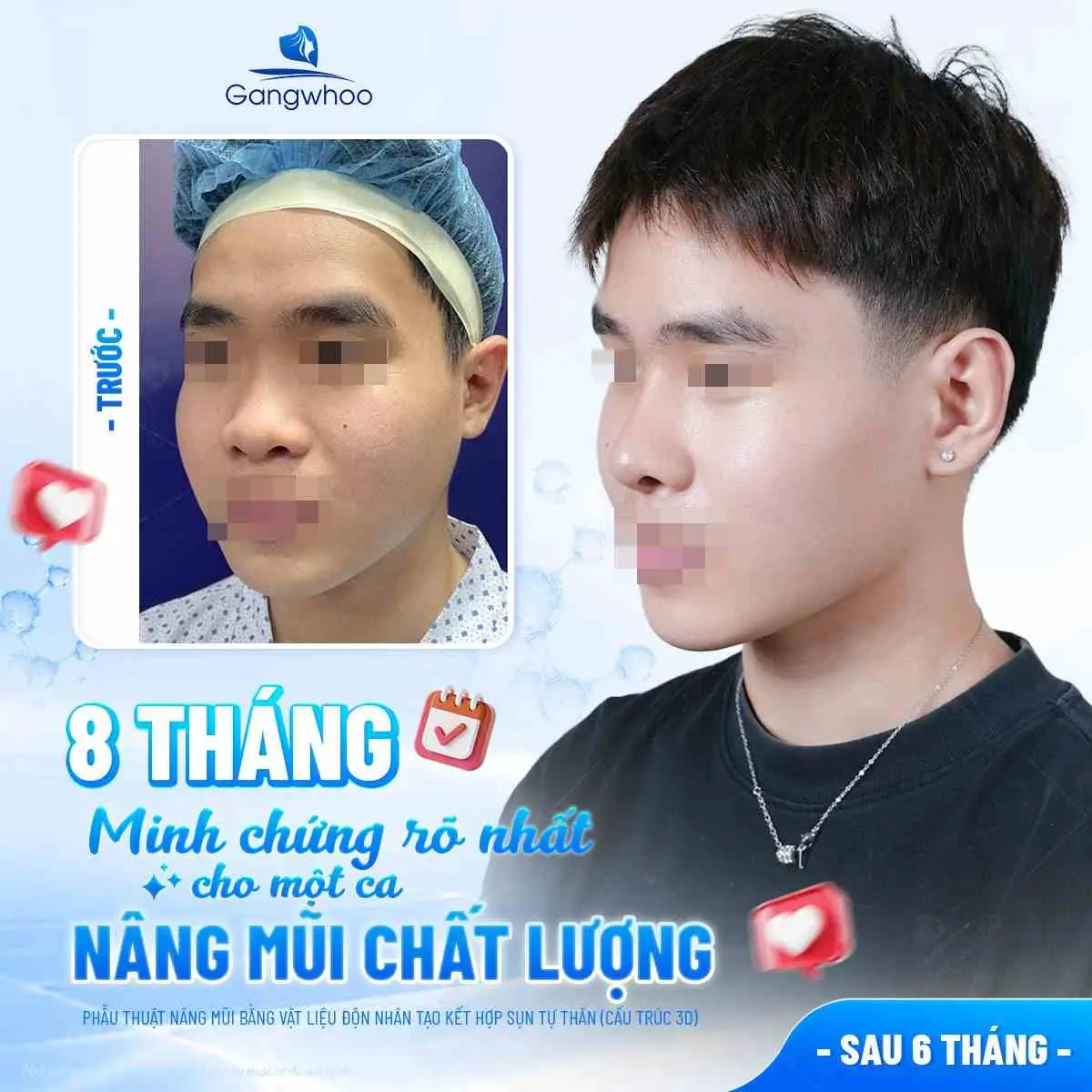 Những cách giàm đau đầu sau khi nâng mũi
