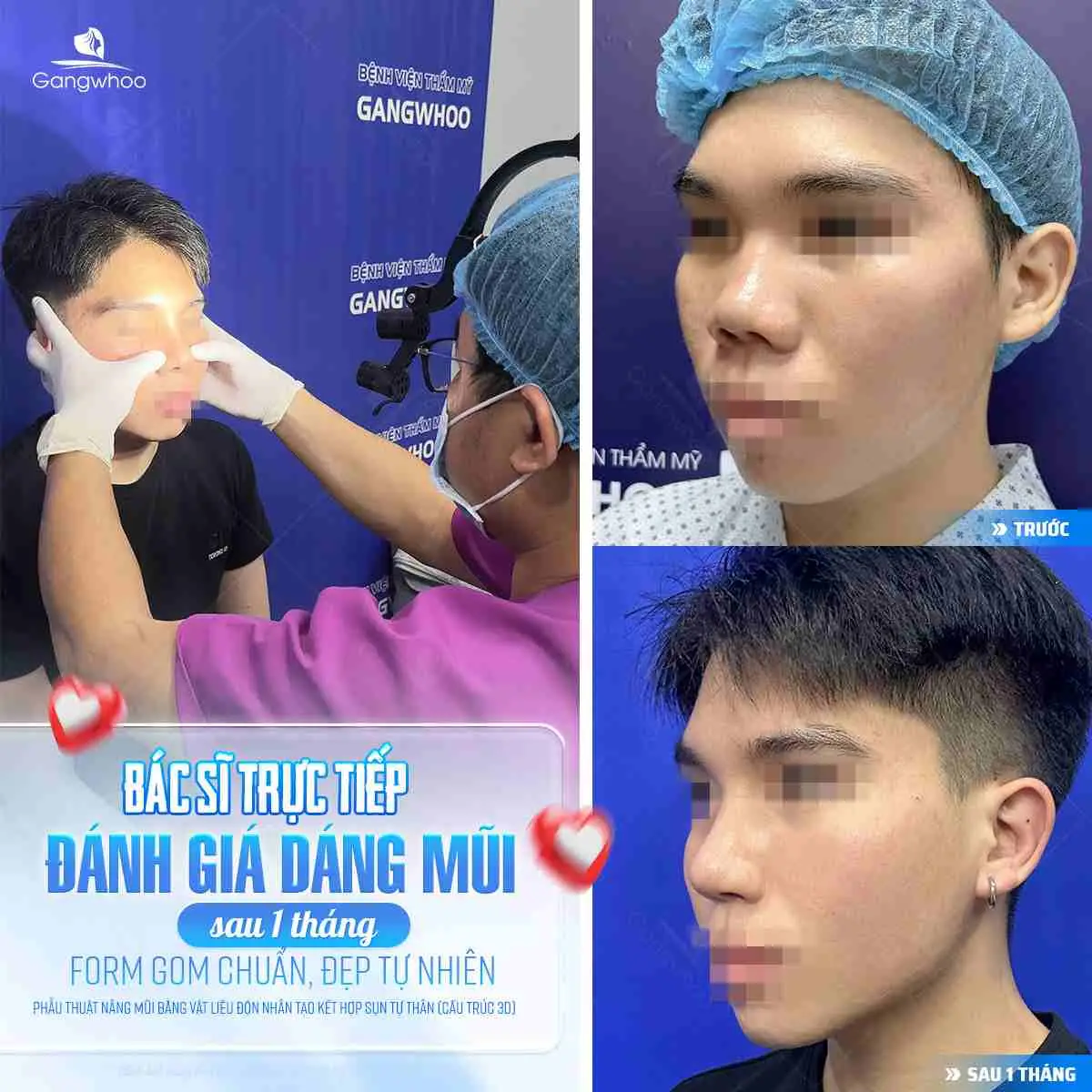 Nâng mũi tại Gangwhoo bạn sẽ được bác sĩ kiểm tra đánh giá chất lượng mũi sau khi nâng