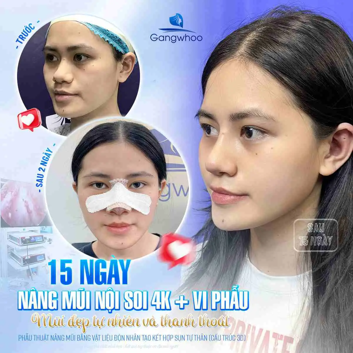 Sau nâng mũi bao lâu thì được xì mũi?