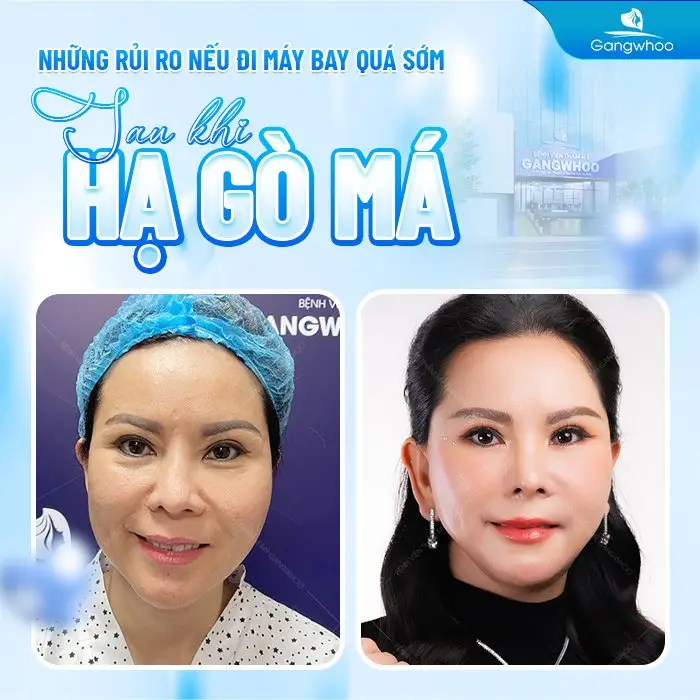 Những rủi ro nếu đi máy bay quá sớm sau hạ gò má