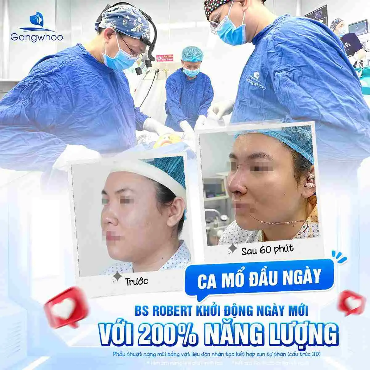 Công nghệ nâng mũi giúp hạn chế sưng nề tại Thẩm mỹ viện Gangwhoo