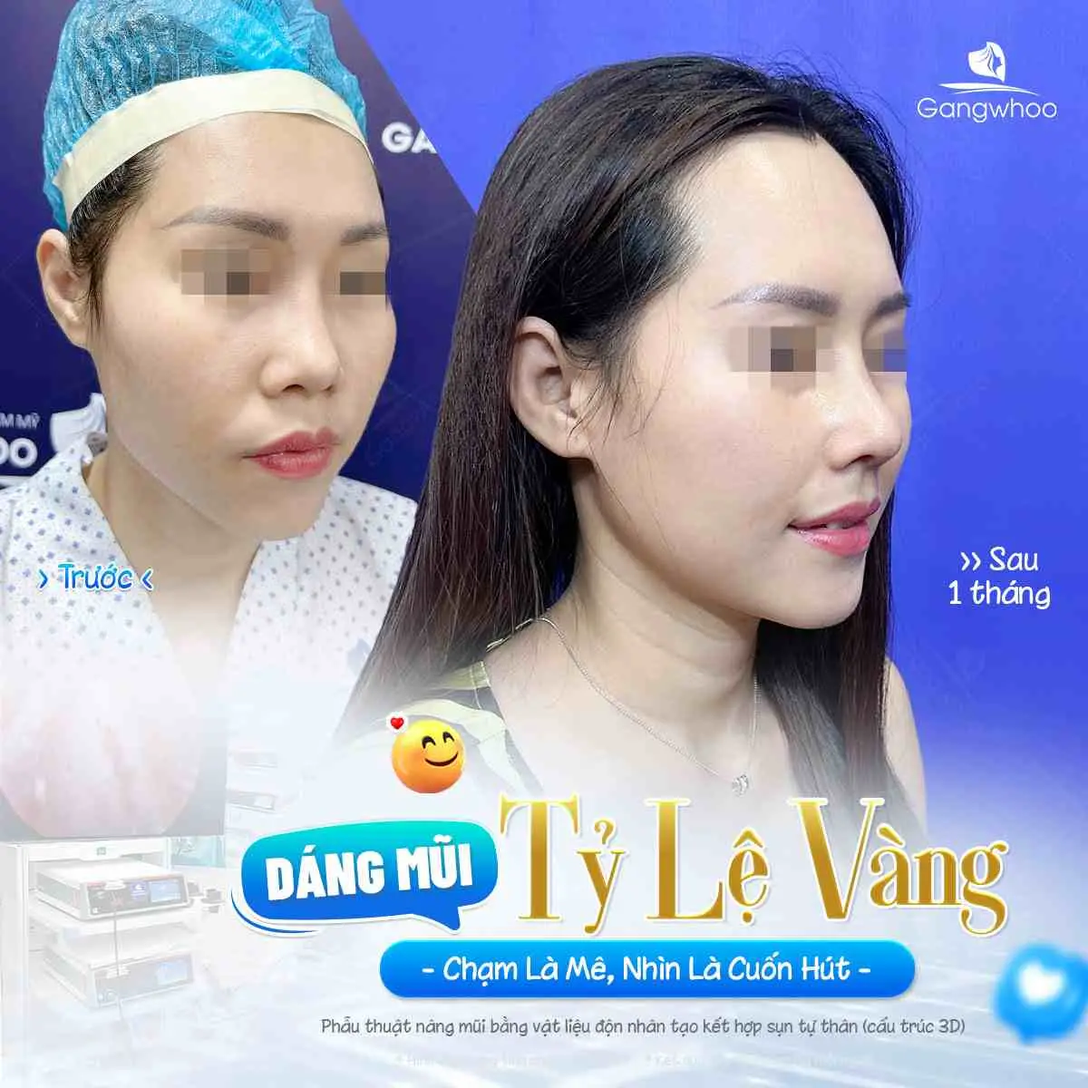 Nâng Mũi Bị Sưng 1 Bên Có Sao Không? Nguyên Nhân Và Cách Xử Lý