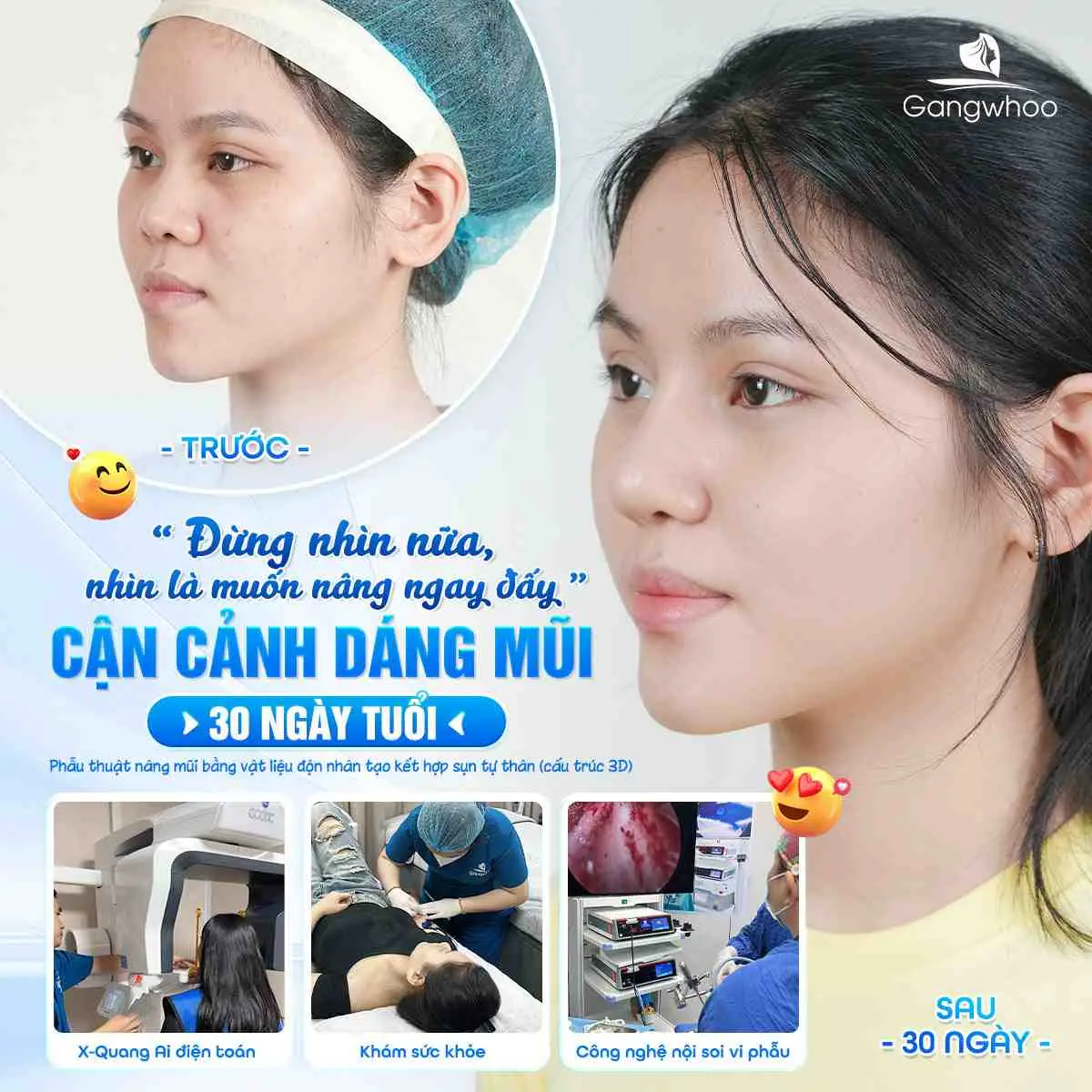 Nâng Mũi Bị Sưng Mắt Có Sao Không? Nguyên Nhân Và Cách Xử Lý