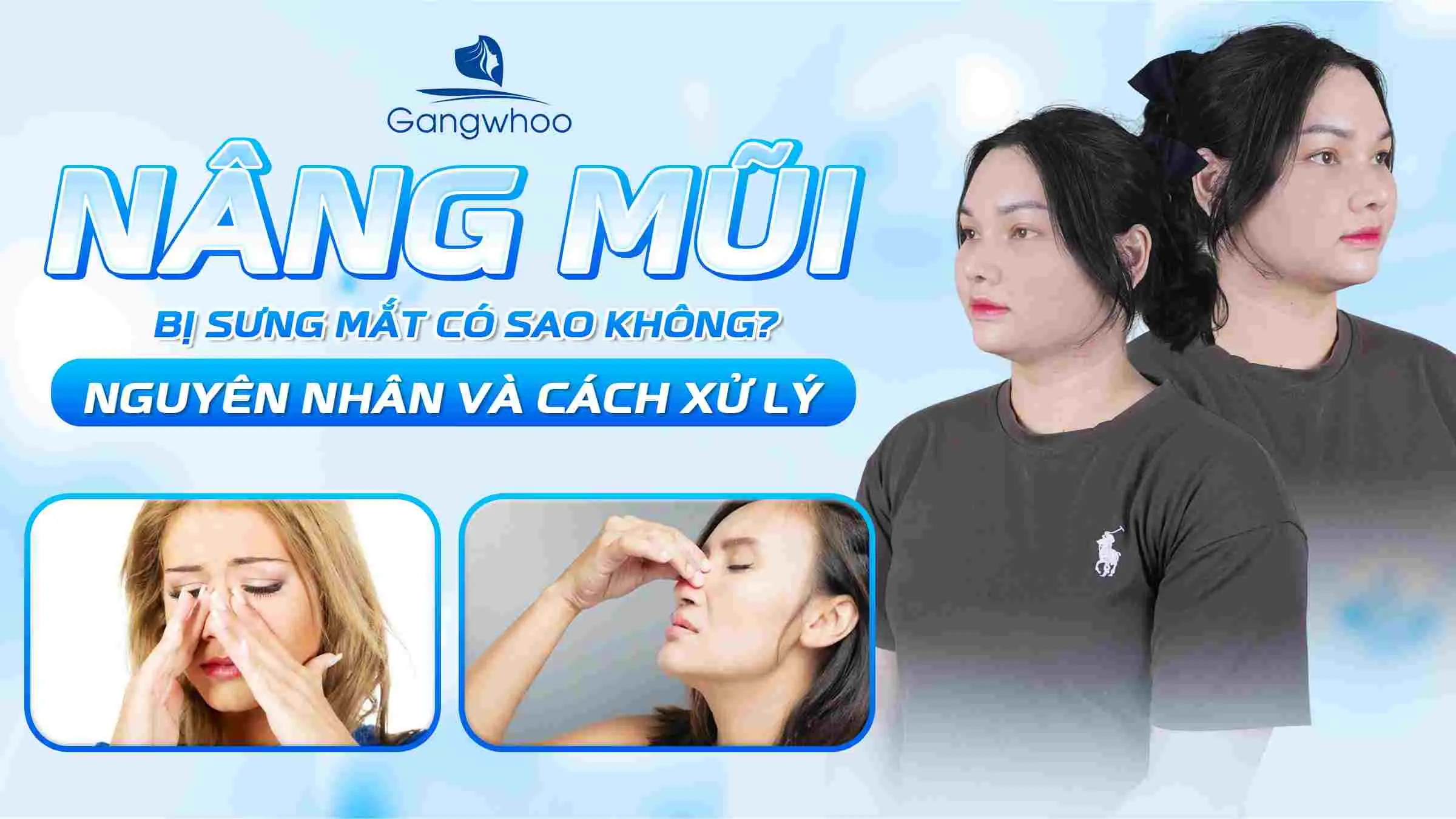 Nâng Mũi Bị Sưng Mắt Có Sao Không? Nguyên Nhân Và Cách Xử Lý