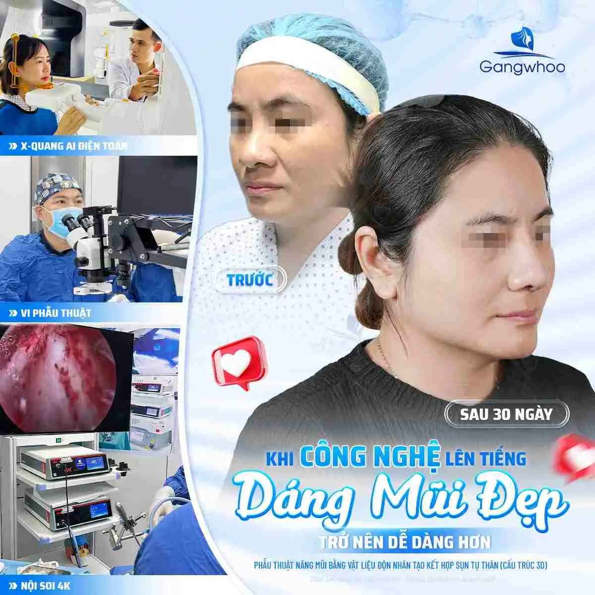 Công nghệ nâng mũi hiện đại tại Thẩm mỹ viện Gangwhoo