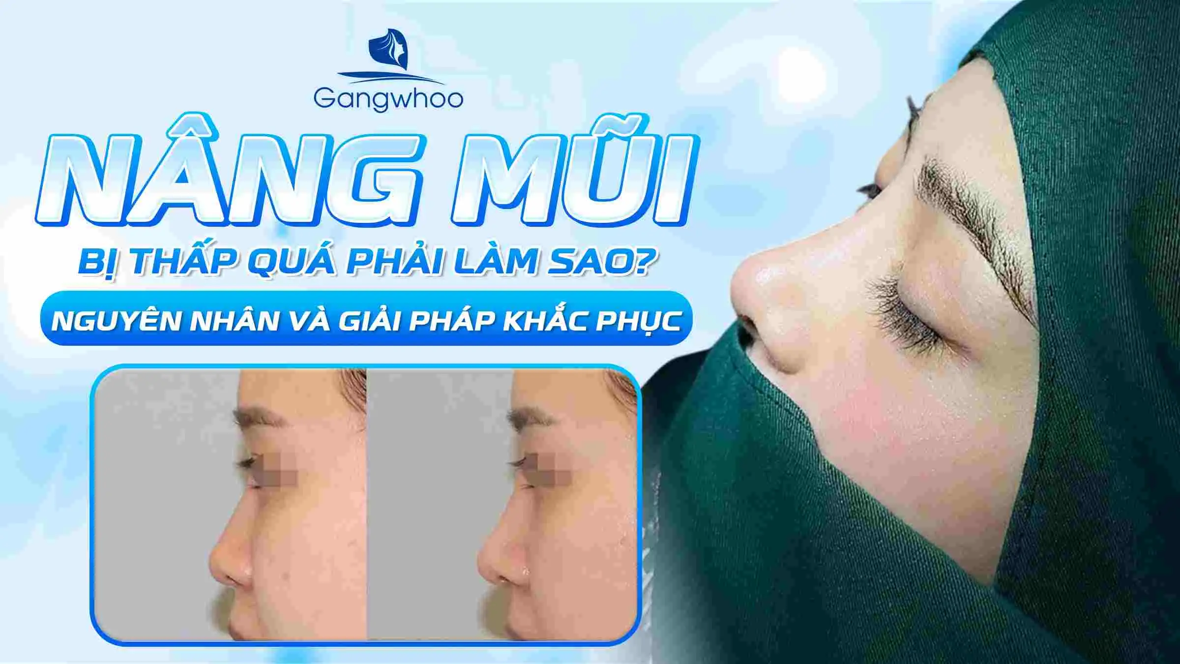 Nâng Mũi Bị Thấp Quá Phải Làm Sao? Nguyên Nhân Và Giải Pháp Khắc Phục