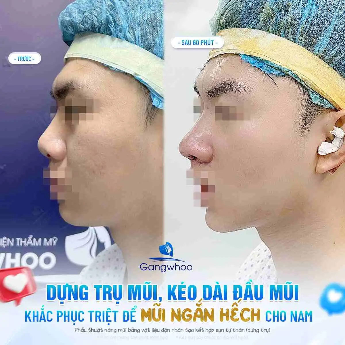 Nâng Mũi Bị Thấp Quá Phải Làm Sao? Nguyên Nhân Và Giải Pháp Khắc Phục