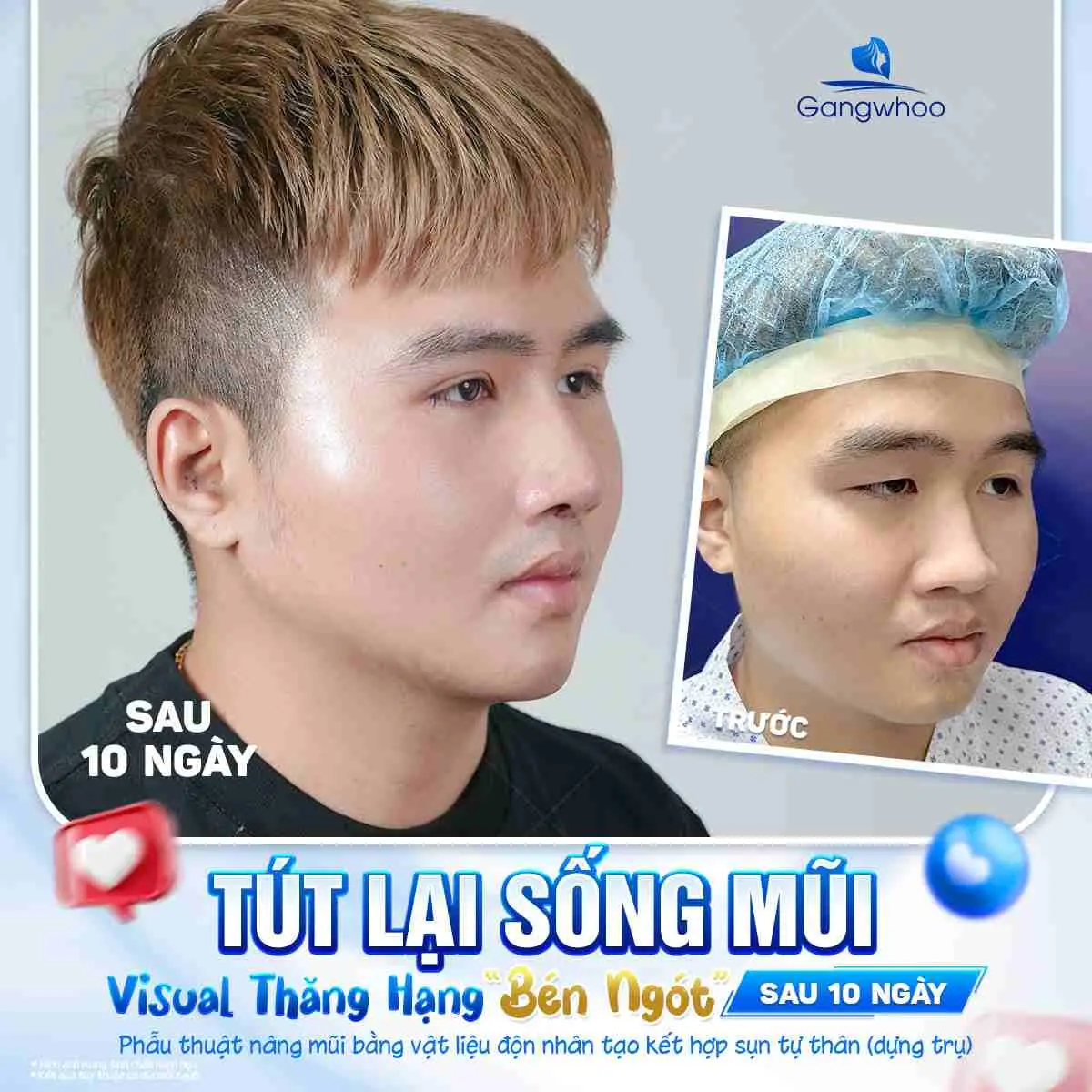 Nâng Mũi Bị Thủng Vách Ngăn Có Nguy Hiểm Không? Nguyên Nhân Và Cách Xử Lý