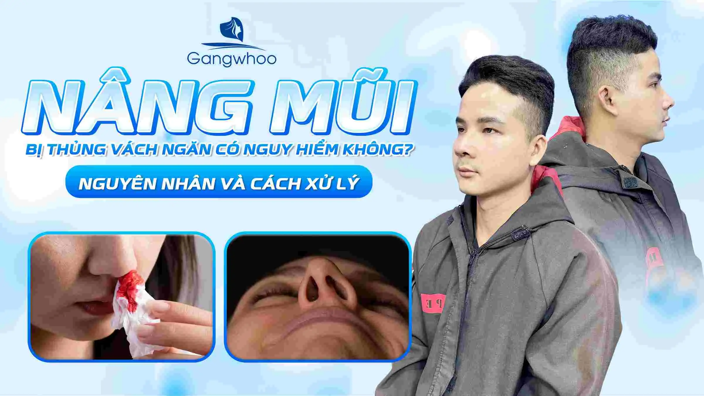 Nâng Mũi Bị Thủng Vách Ngăn Có Nguy Hiểm Không? Nguyên Nhân Và Cách Xử Lý