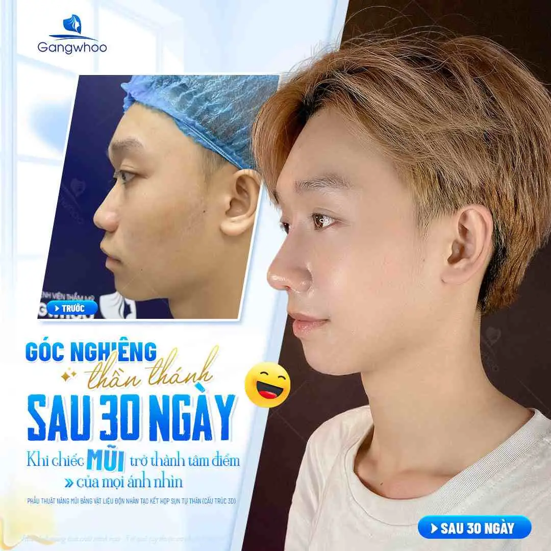Nâng Mũi Bị Va Chạm Có Sao Không? Cách Xử Lý Và Phòng Tránh