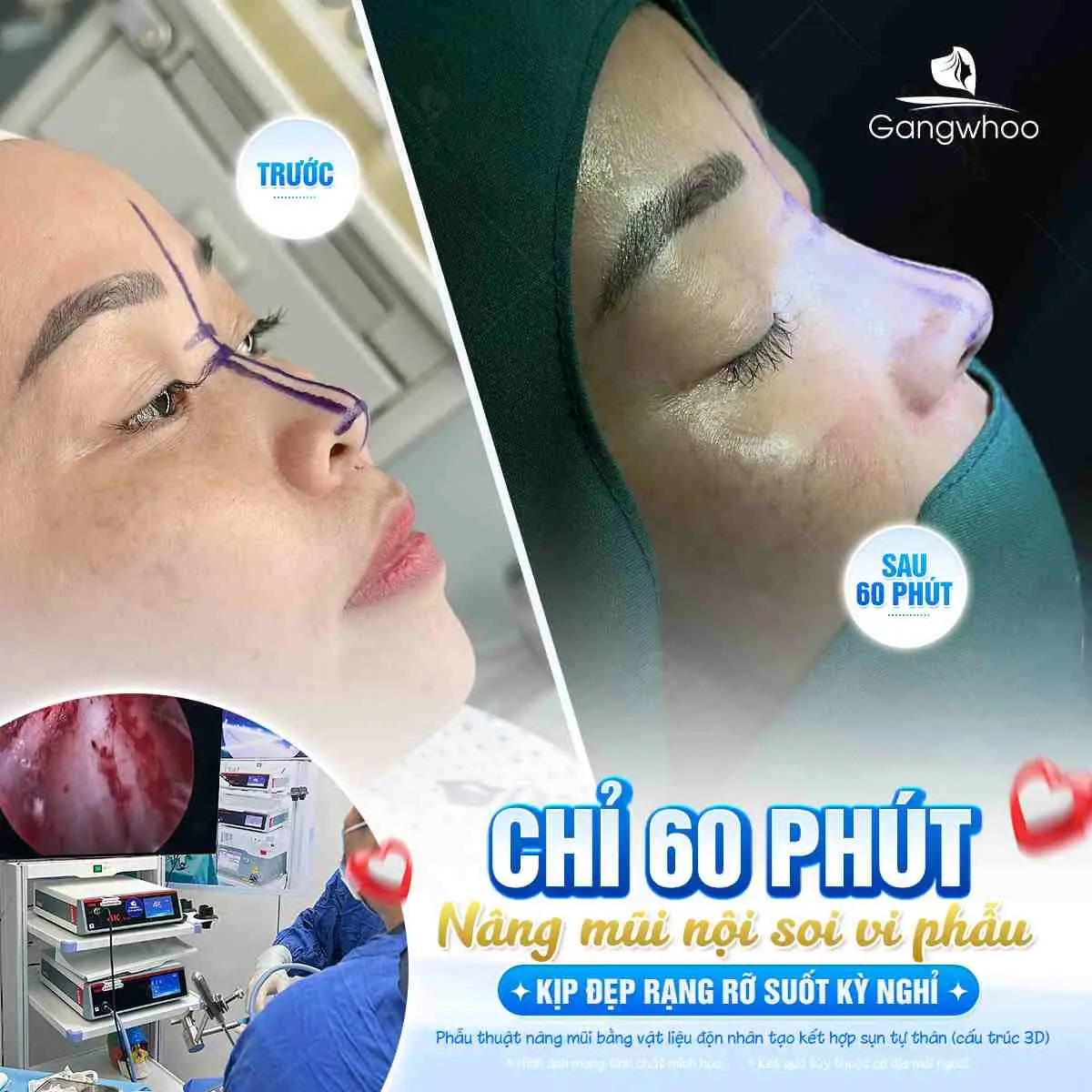 Các dấu hiệu cần chú ý sau khi mũi bị va chạm