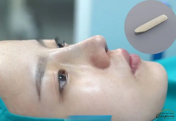 Nâng Mũi Bọc Megaderm Là Gì? Có Nên Thực Hiện Không?