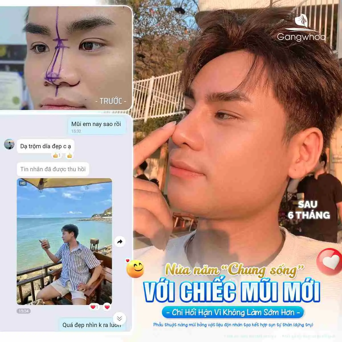 Nâng Mũi Bọc Megaderm Là Gì? Có Nên Thực Hiện Không?