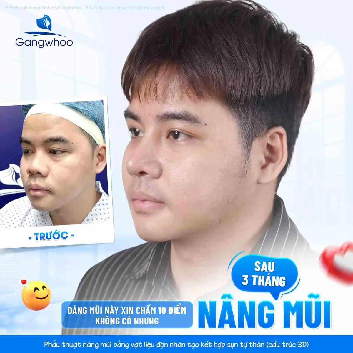 Nâng Mũi Bọc Cân Thái Dương Là Gì? Ưu Điểm Và Khi Nào Nên Thực Hiện