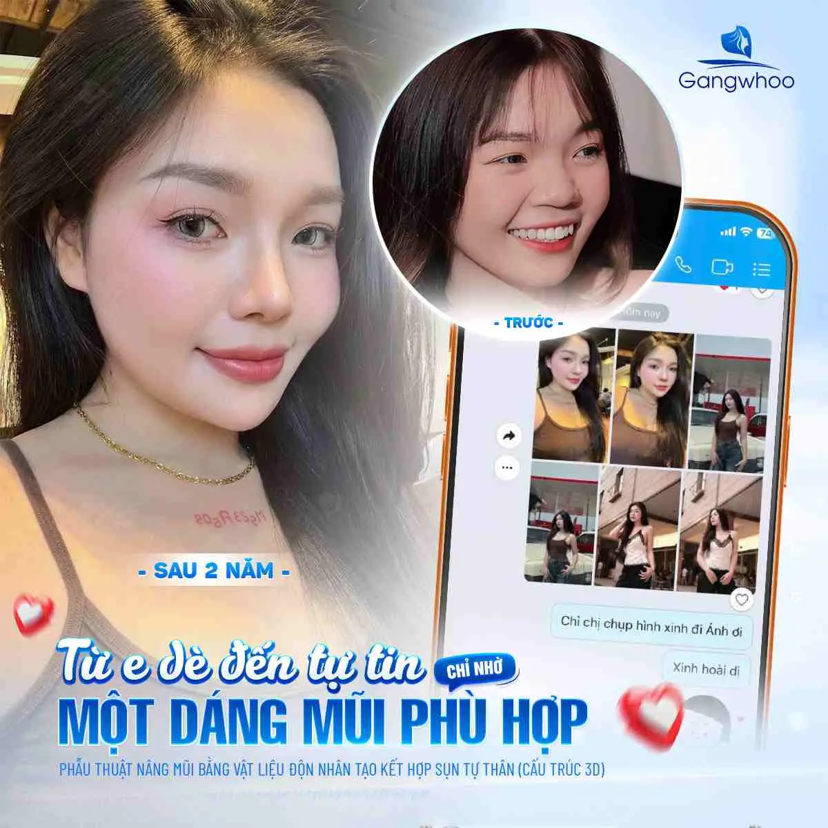 Những ai phù hợp để nâng dáng mũi cao tây