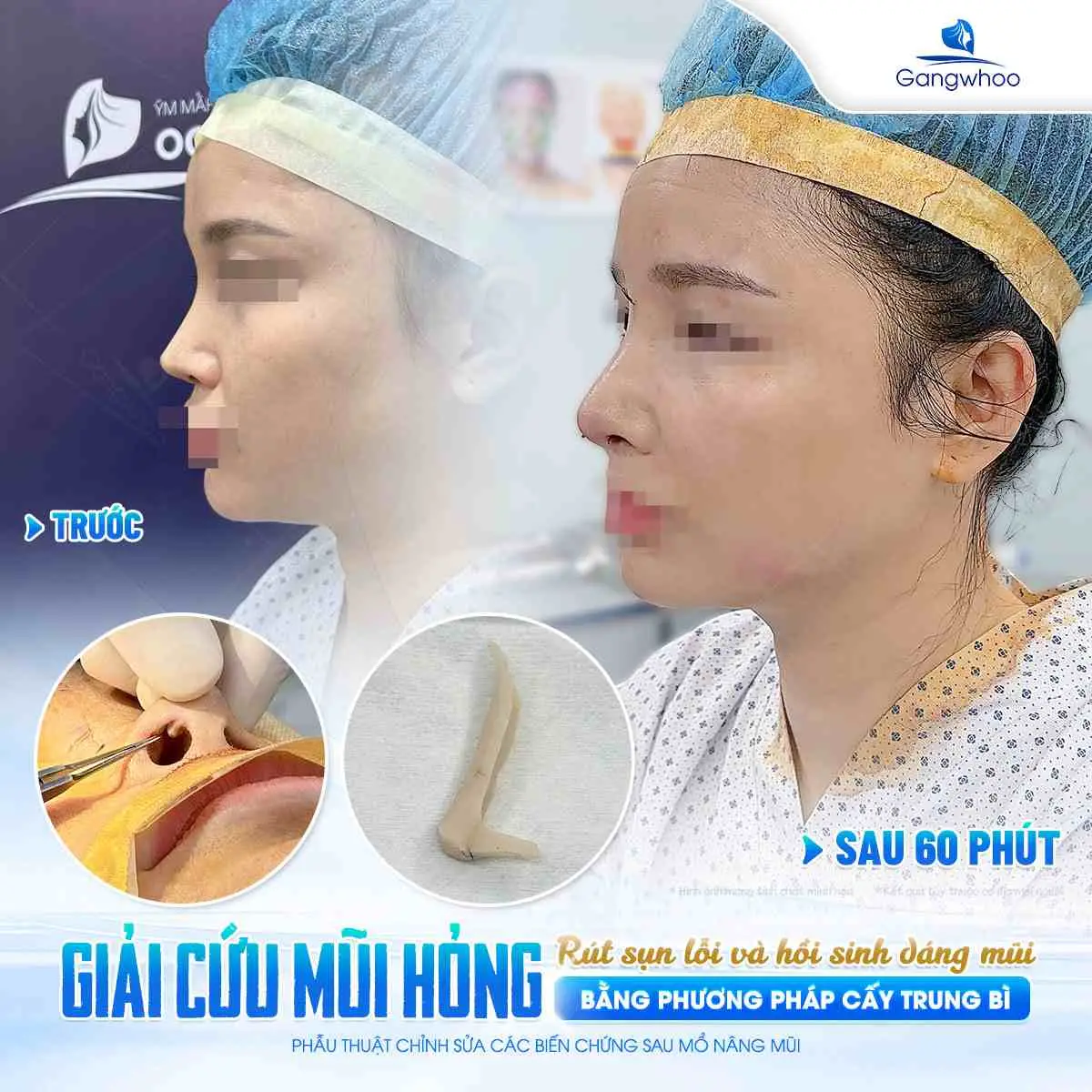 Rủi ro khi nâng mũi cao quá mức