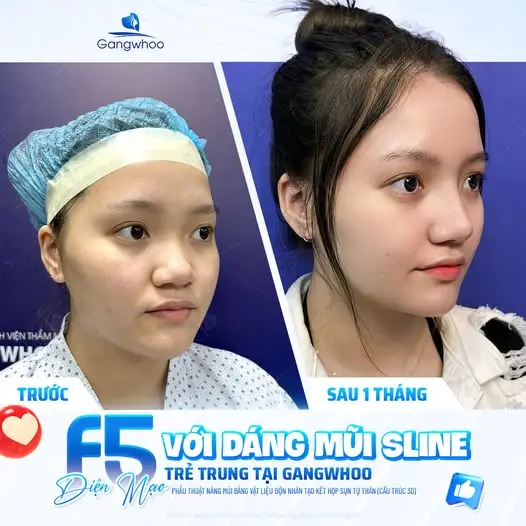 Dáng mũi S Line tự nhiên