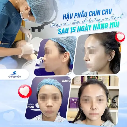 Sau nâng mũi bao lâu thì được ăn thịt ngan