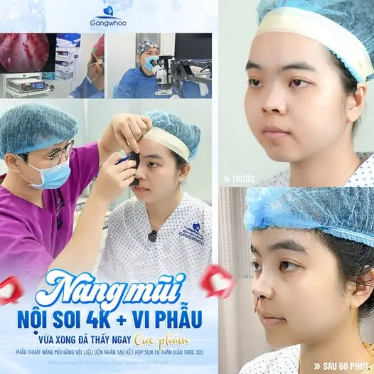 Thời điểm ăn mắm nêm an toàn sau khi nâng mũi
