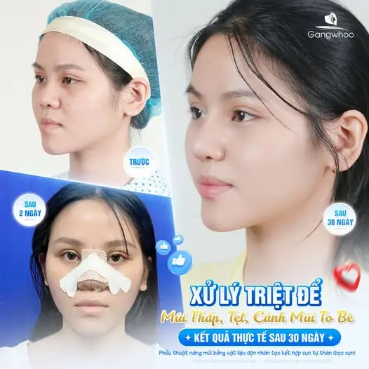 Nâng Mũi Có Bảo Hành Không? Những Điều Bạn Cần Biết Trước Khi Thực Hiện