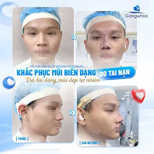 Những trường hợp được bảo hành sau nâng mũi