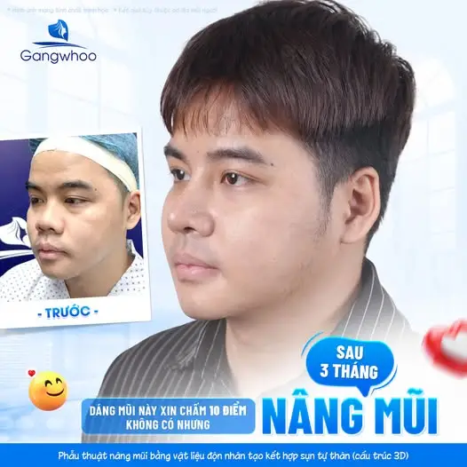 Những lý nên lựa chọn TMV có chính sách bảo hành sau nâng mũi