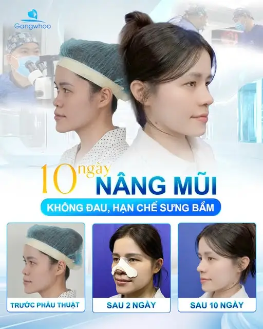 Khi nào cần cân nhắc làm lại CMND/CCCD sau nâng mũi?