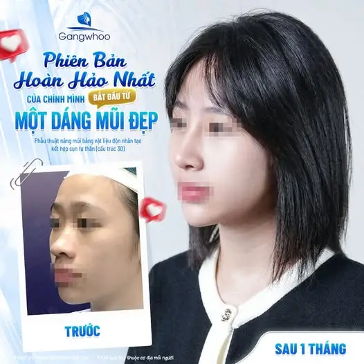 Nâng Mũi Có Cần Xét Nghiệm Máu Không? Vì Sao Đây Là Bước Không Thể Bỏ Qua
