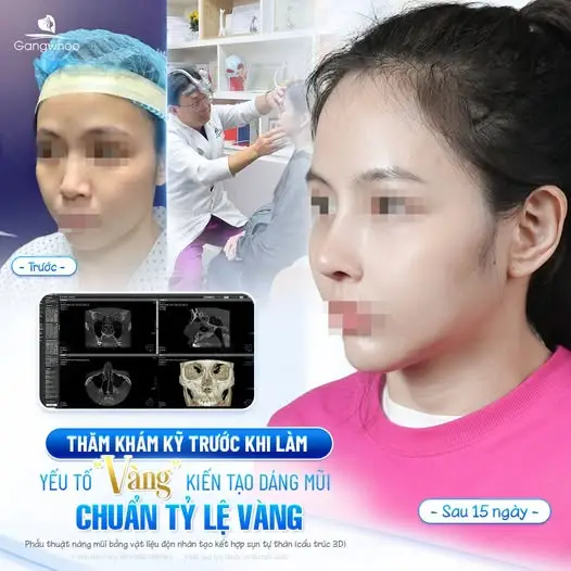 Những xét nghiệm cần thực hiện trước khi nâng mũi tại Gangwhoo