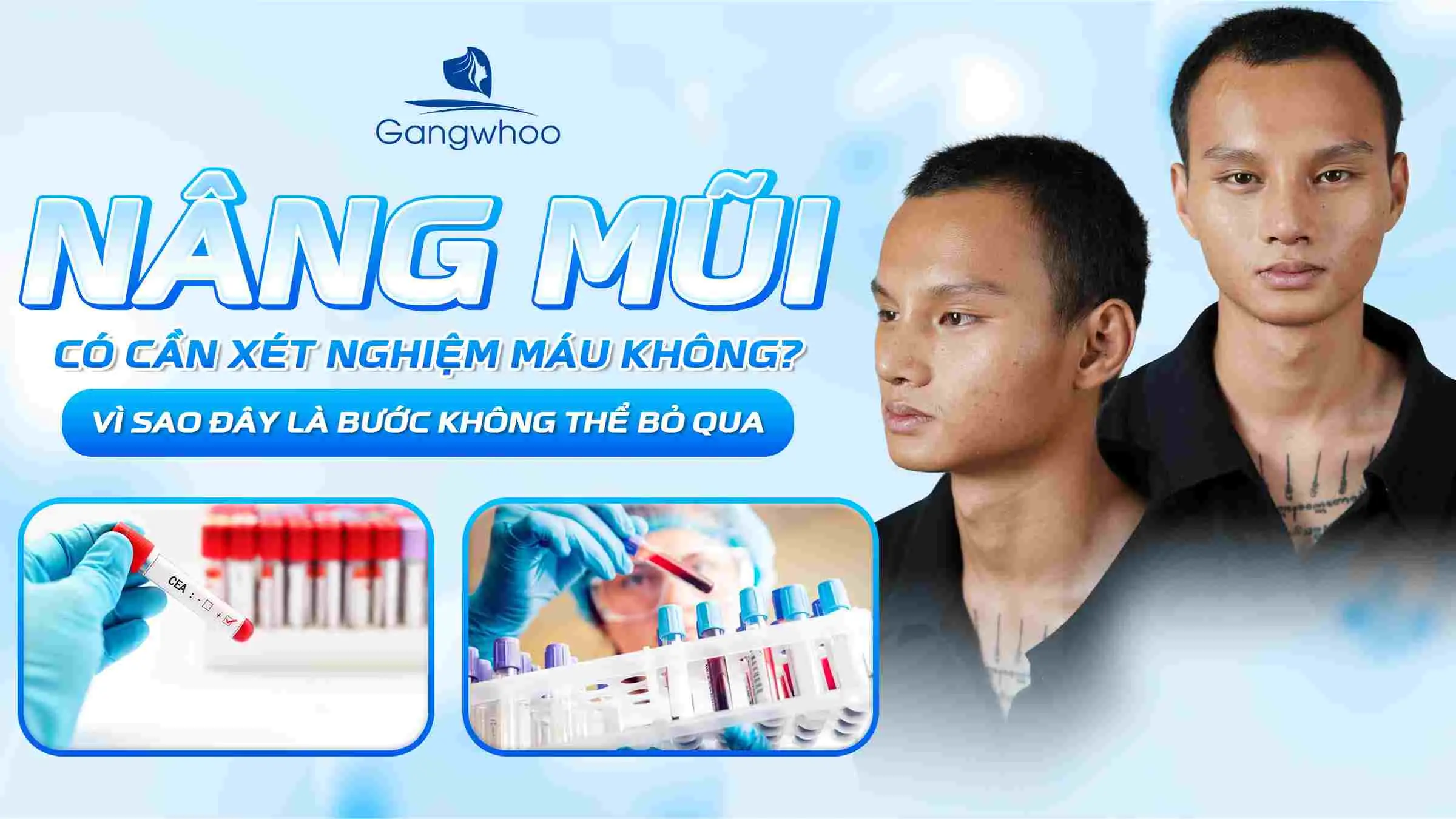 Nâng Mũi Có Cần Xét Nghiệm Máu Không? Vì Sao Đây Là Bước Không Thể Bỏ Qua