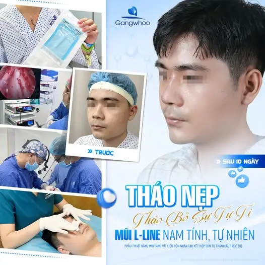 Thời gian có thể chơi thể thao sau nâng mũi