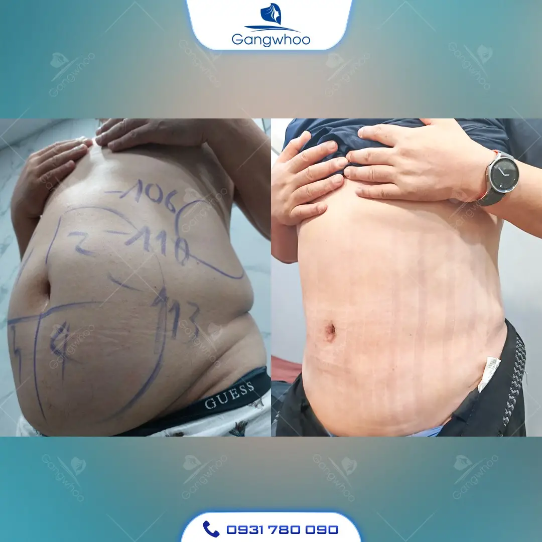 Hình ảnh khách hàng hút mỡ