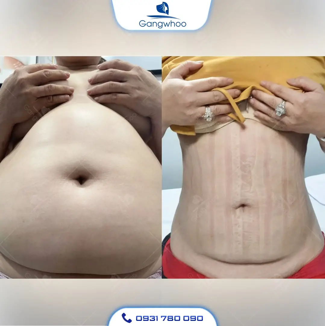Hình ảnh khách hàng hút mỡ